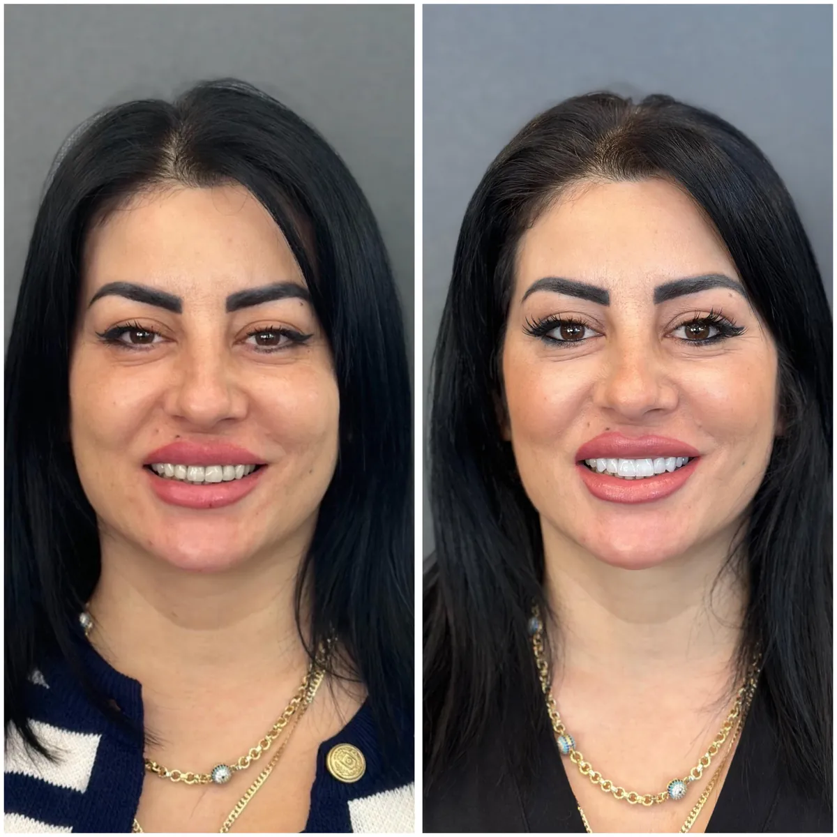 Turkey teeth before and after in Istanbul – case 1