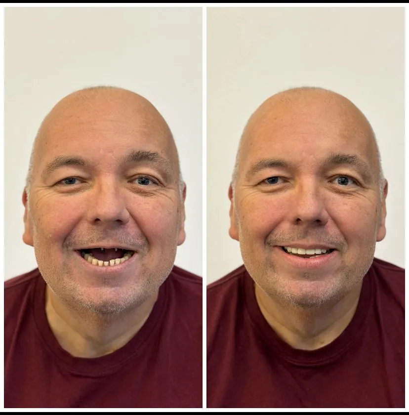What do Turkey teeth look like – case 2