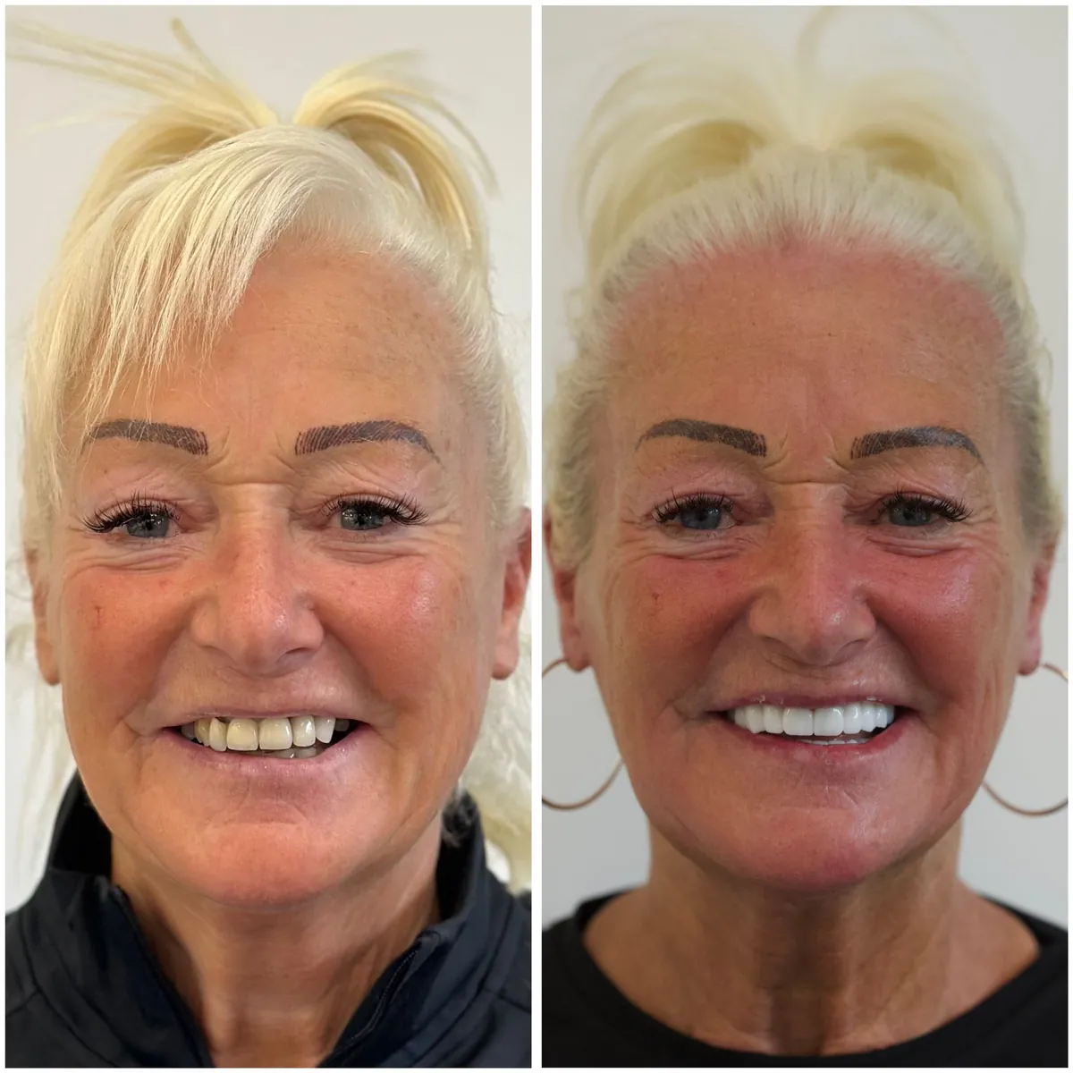Turkey teeth before and after – case 4