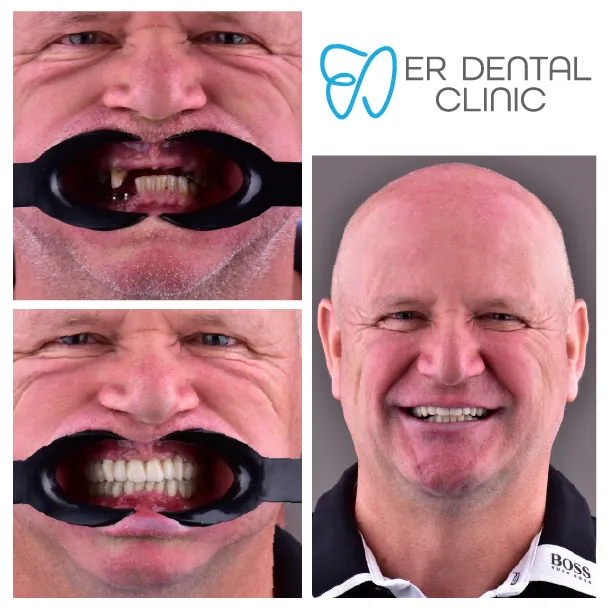 Turkey teeth before and after – case 7