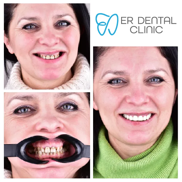 What do Turkey teeth look like – case 8