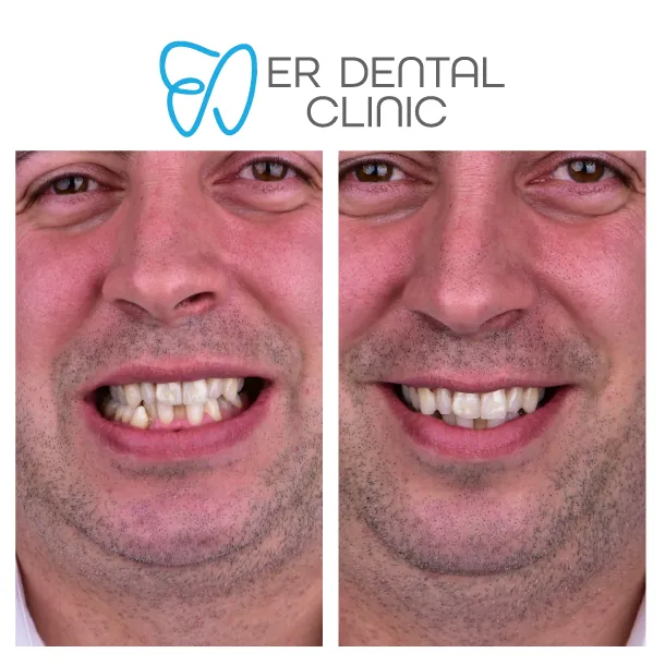What do Turkey teeth look like – case 11