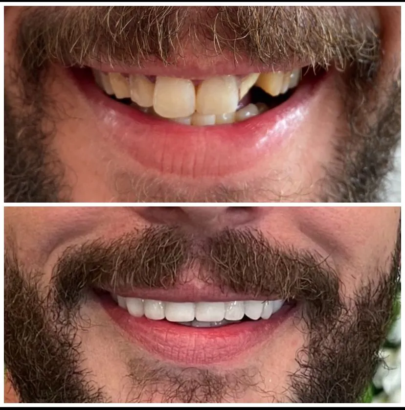 What do Turkey teeth look like – case 14