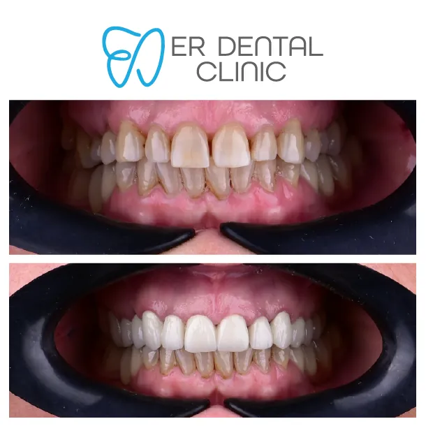 Turkey teeth before and after – case 16