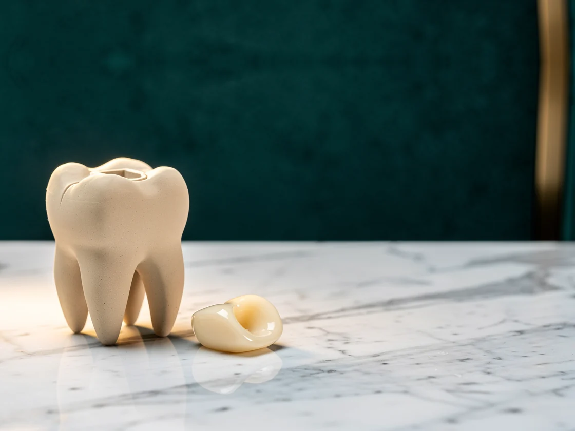 Dental inlays and onlays Istanbul
