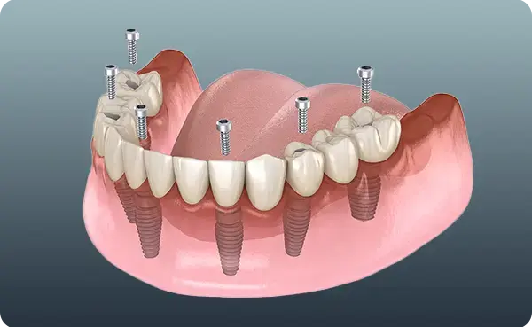 All-on-6 Implants