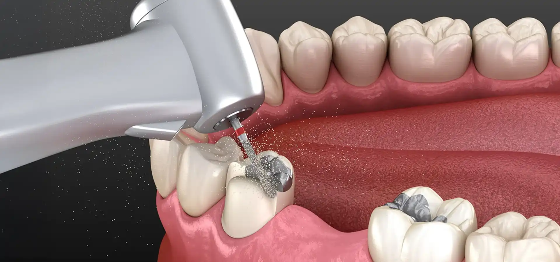 Tooth Fillings (Amalgam & Composite) in Istanbul, Turkey