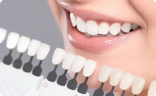 Composite Veneers