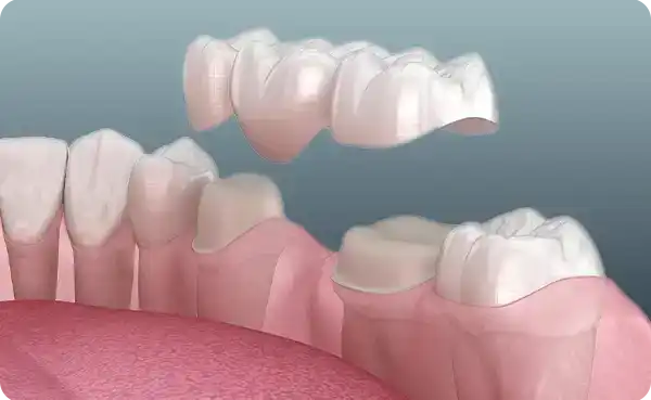 Full Ceramic Crowns