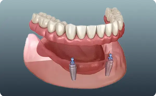 Full Mouth Implants