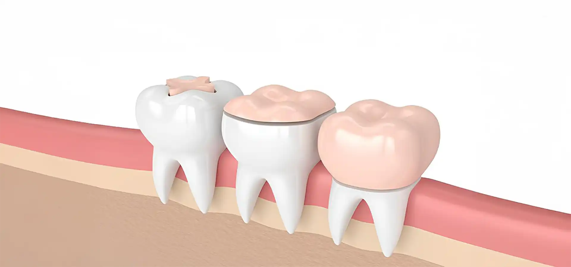 Inlay & Onlay Dental Restorations in Istanbul, Turkey