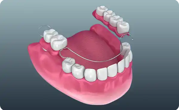 Partial Dentures