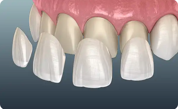 Porcelain Veneers