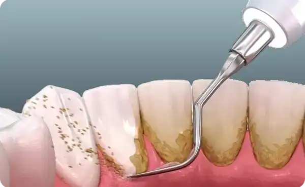 Dental Cleaning (Scaling & Polishing)