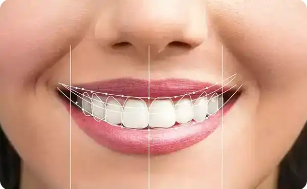 Smile Makeover