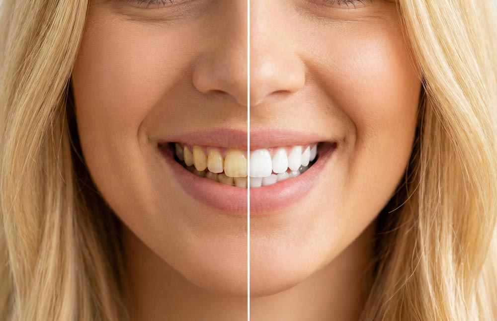 Smile Makeover in Istanbul