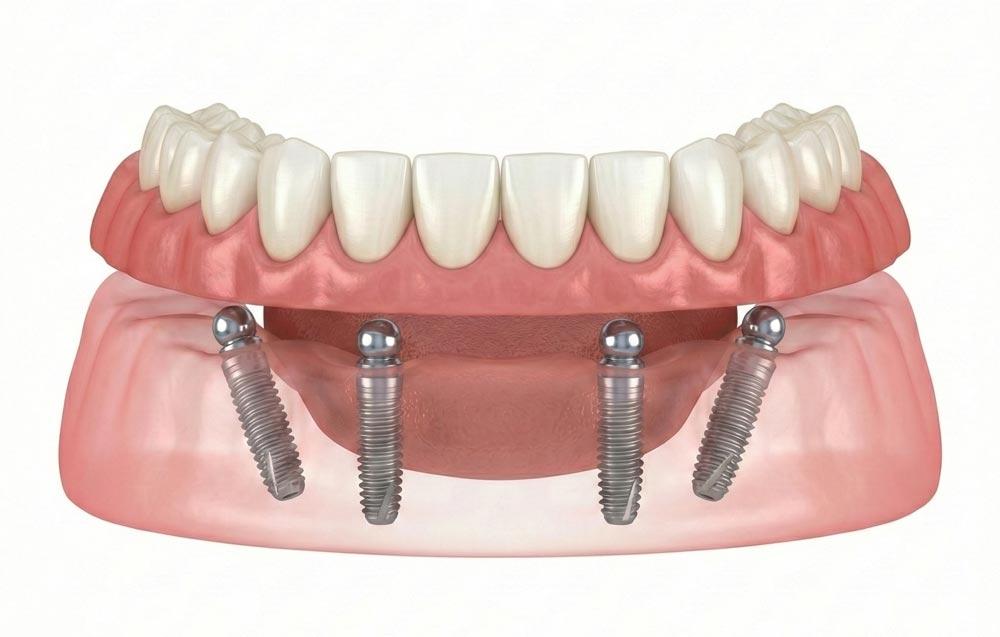 Implant Supported Dentures istanbul turkey