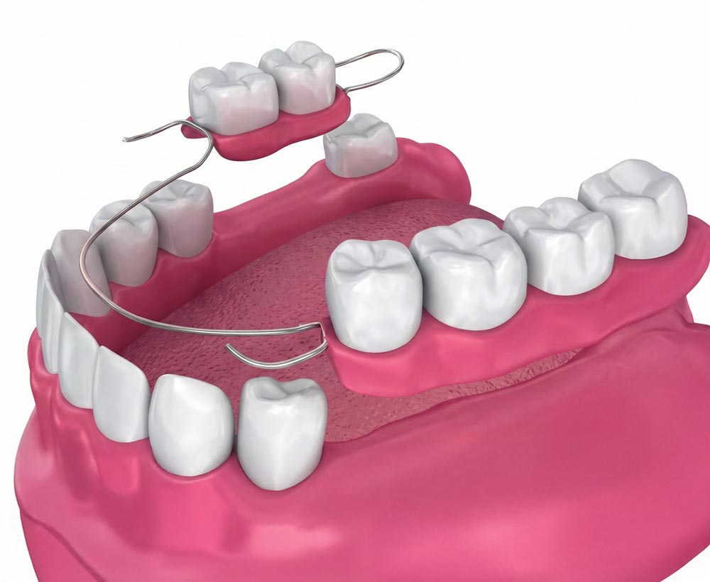 Partial Dentures istanbul turkey